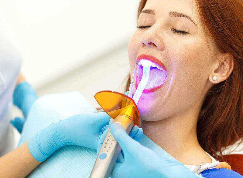 Dental Bonding Leduc