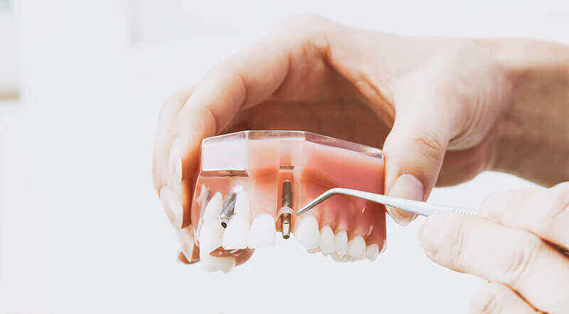 Dental Implants Leduc