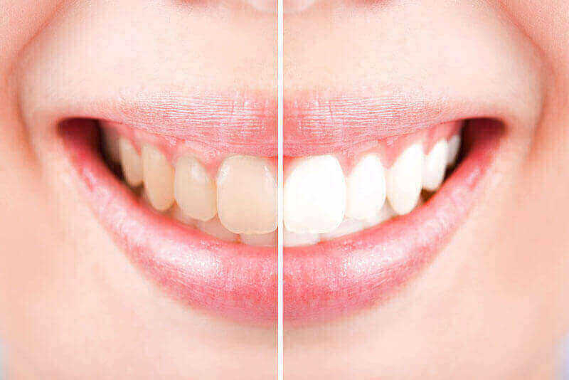 Teeth Whitening Leduc